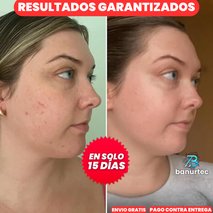 Niaglow S10 | Serum Anti Acné Ultra Concentrado con Ácido Salicílico